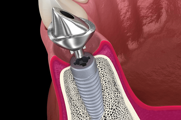 a 3 D digital illustration of an implant and abutment