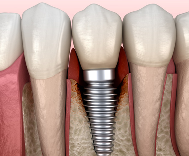Bone loss around a failed dental implant