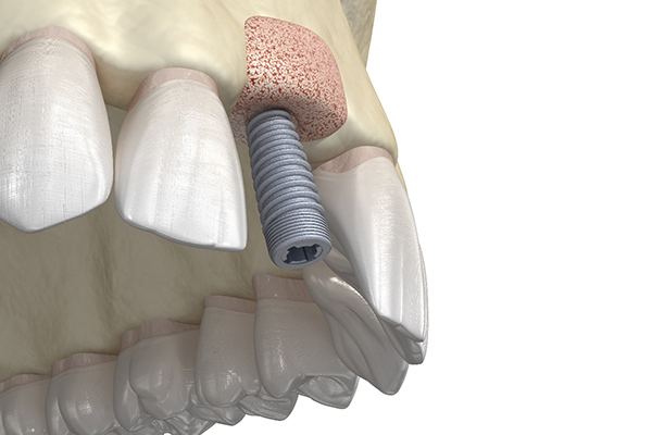 3D render of a dental implant