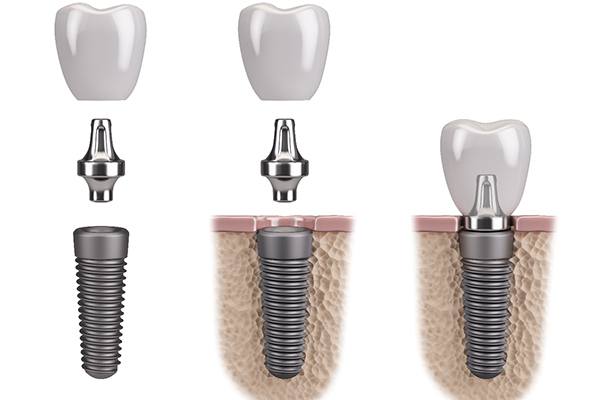 Dental implant in three parts