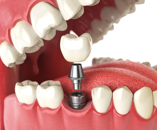 Animated dental implant abutment and dental crown being placed into the lower jaw