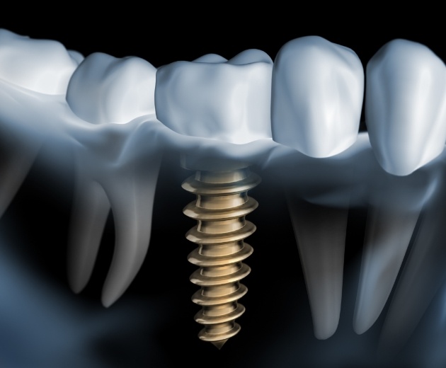 Model of a dental implant in Reston with a dental crown