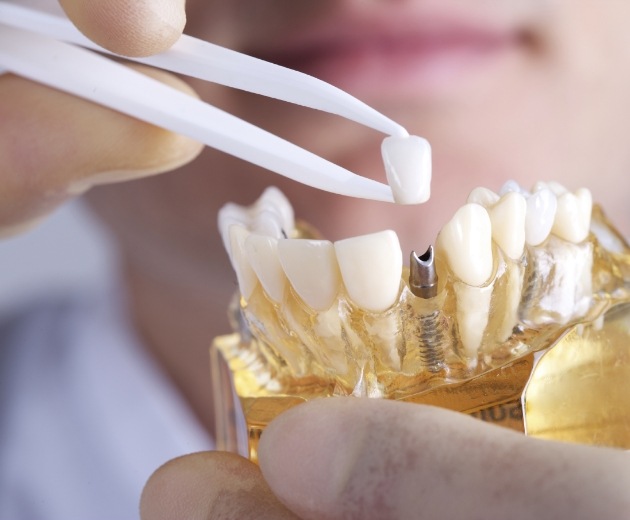 Dentist placing a dental crown on a model of a dental implant