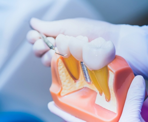 Dentist pointing to a model of a dental implant in the jaw