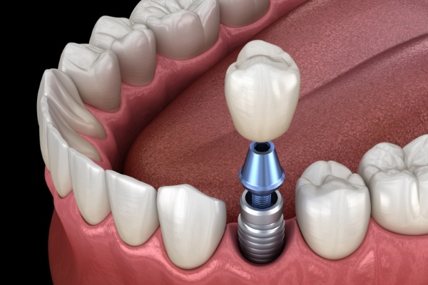 Animated dental implant supporting a dental crown