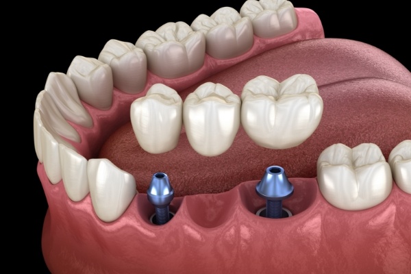 Two animated dental implants supporting a dental bridge