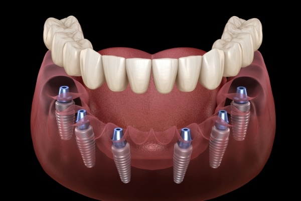 Six animated dental implants supporting a full implant denture