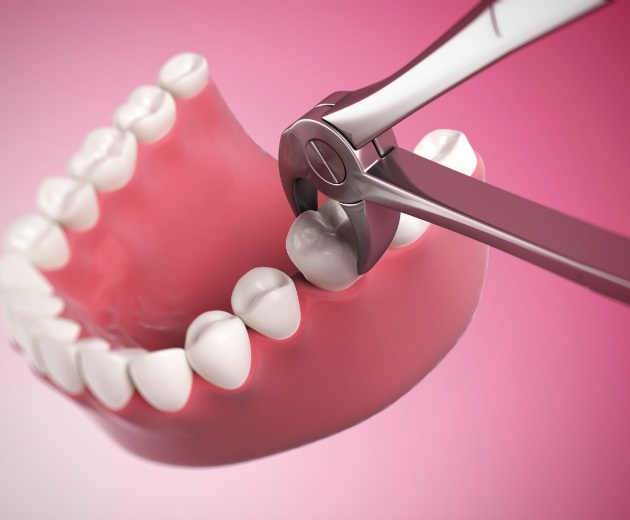 Animated tooth being extracted by dental forceps