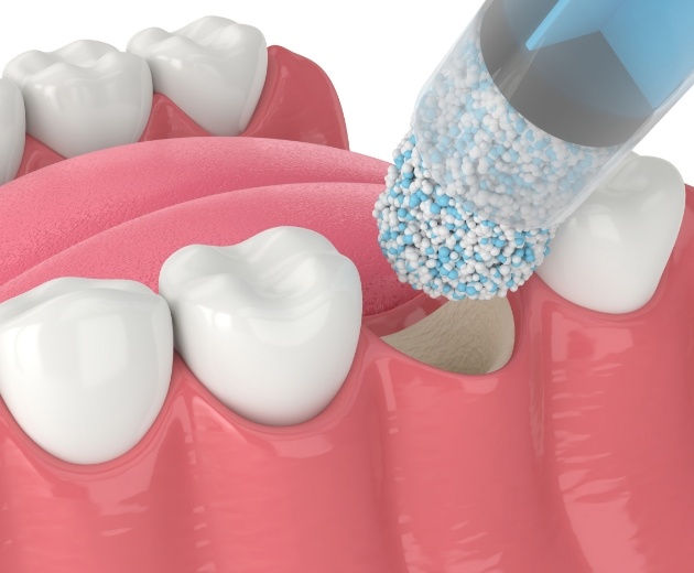 Animated bone grafting material being placed in the socket of a missing tooth