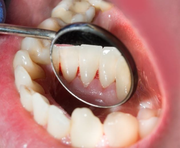 Close up of a mouth with some areas of redness in the gums