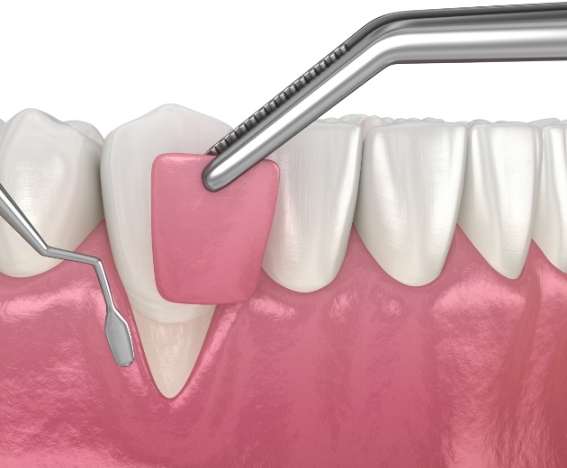 Animated gum graft procedure