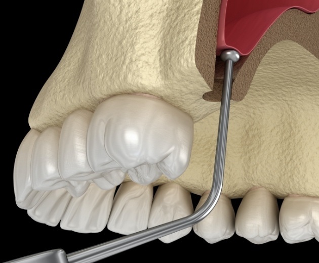 Animated sinus lift procedure