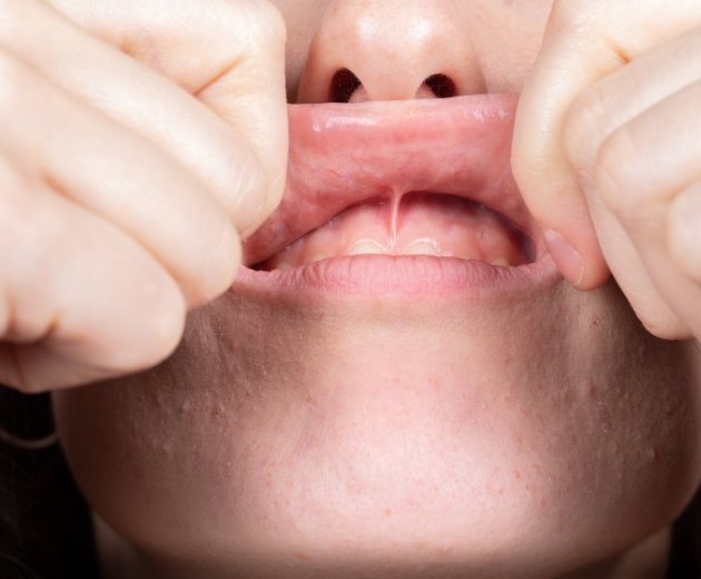 Close up of person pulling back their upper lip