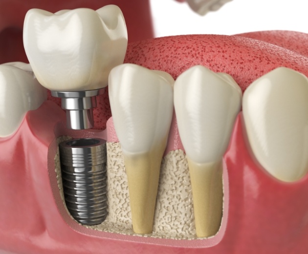 Animated dental implant with dental crown replacing a missing tooth