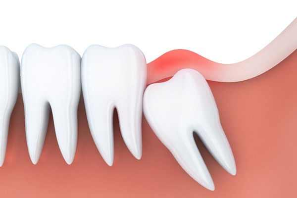 2D render of an impacted wisdom tooth