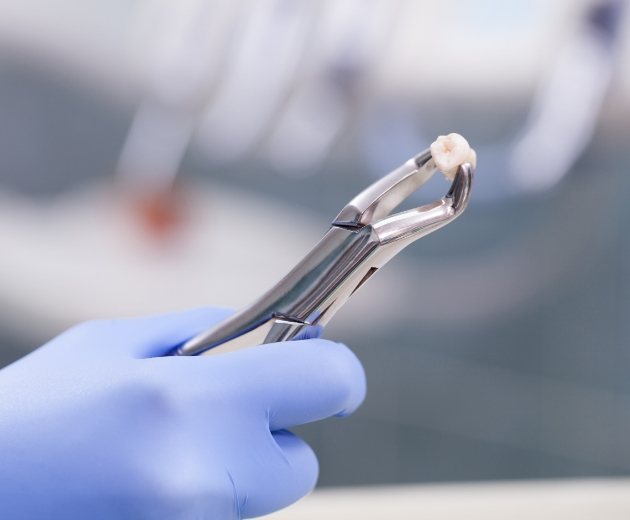 Dental forceps holding a tooth after wisdom teeth extractions in Reston