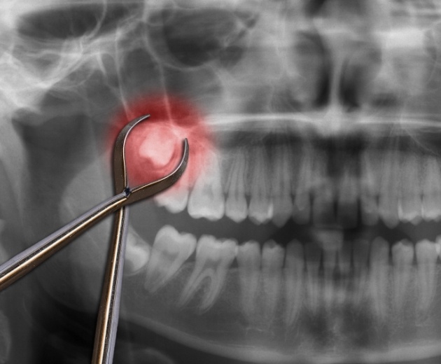 Dental x ray with location of impacted wisdom tooth highlighted red