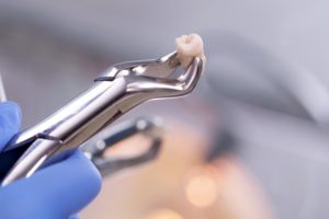 dental pliers holding a wisdom tooth