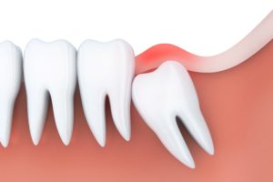 Model of an impacted wisdom tooth