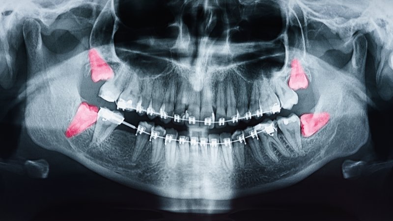 An X-ray highlighting the wisdom teeth